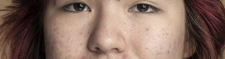 K-Beauty Routine for Acne-Prone Skin (Plus Diet Tips That Actually Work)