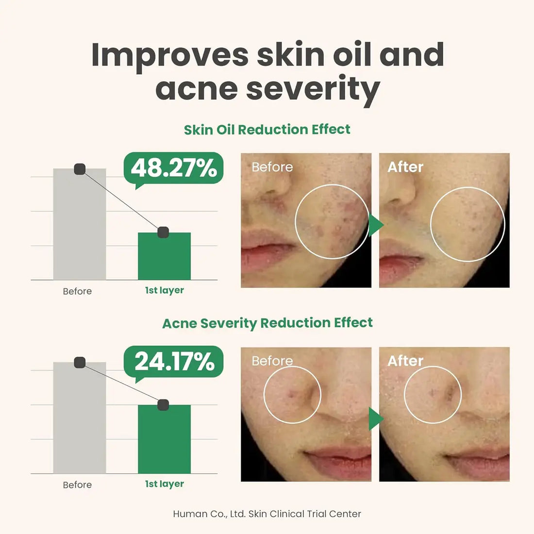 Before and after effects of a skincare product on skin oil and acne severity with statistical data.