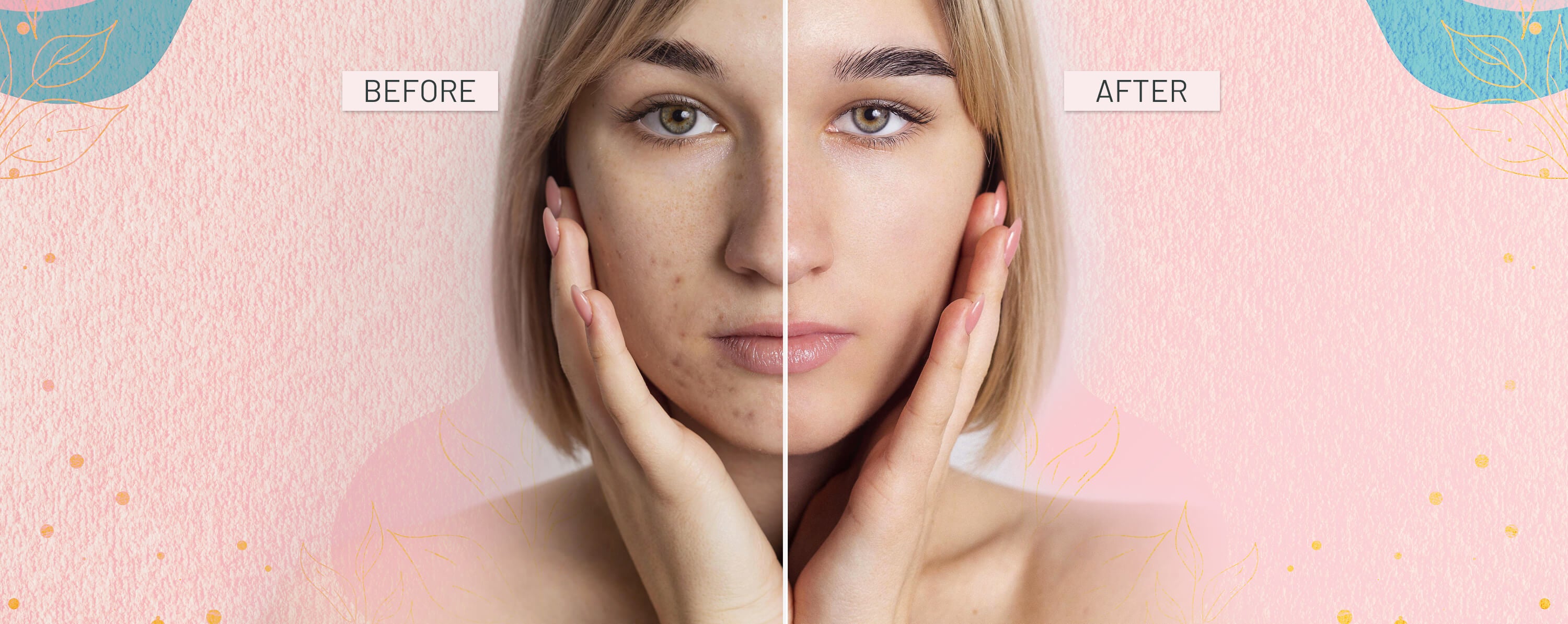 Before and after comparison of a person's face with visible Acne improvement on a pink background.