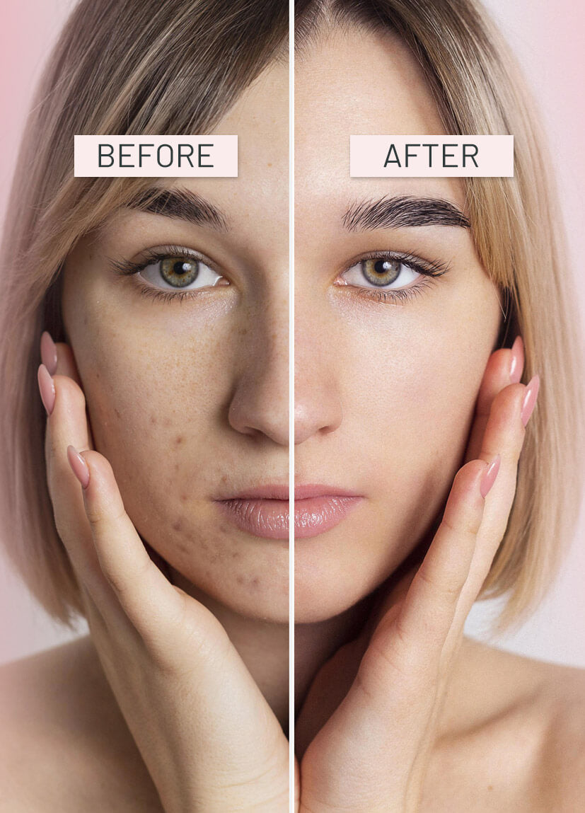 Before and after comparison of a woman's face with visible skin improvement.