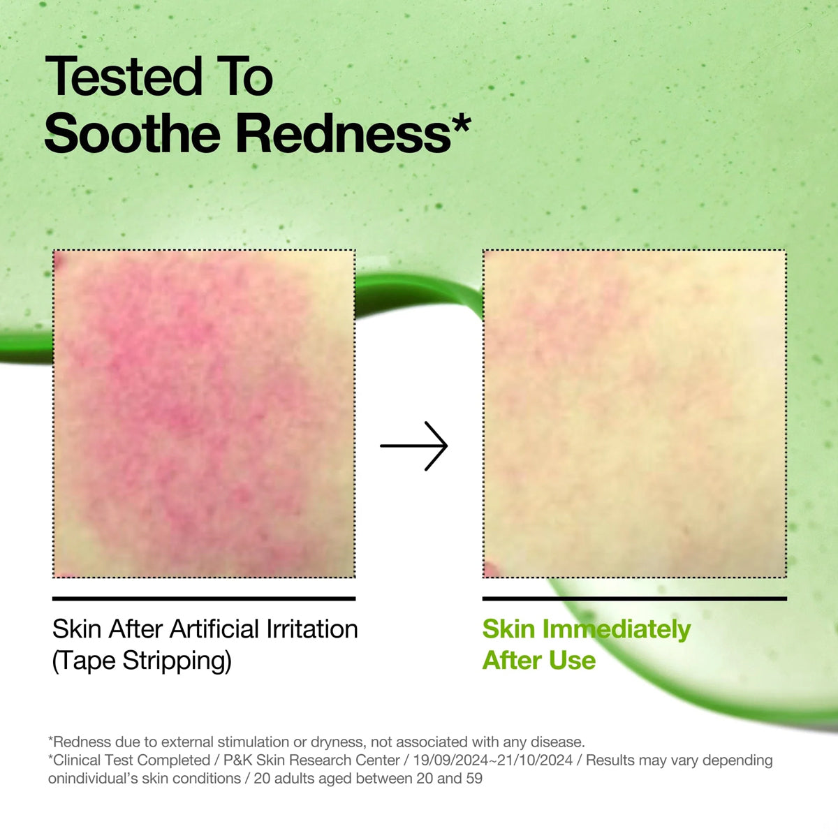 Anua Azelaic Acid 10 Hyaluron Redness Soothing Serum 30ml – Korean skincare serum for sensitive, acne-prone skin with redness and dehydration. Effects