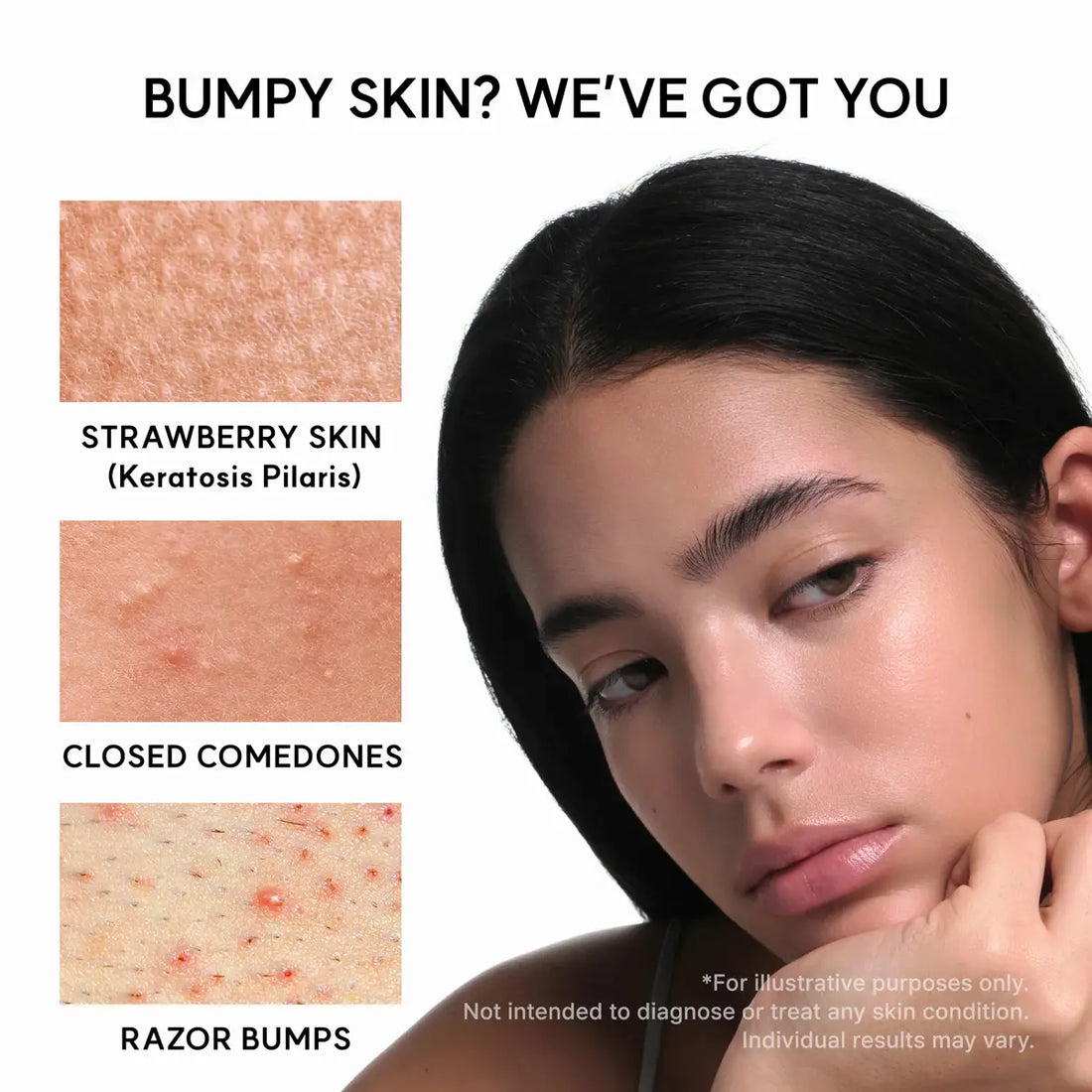 Woman with bumpy skin next to images of strawberry skin, closed comedones, and razor bumps.