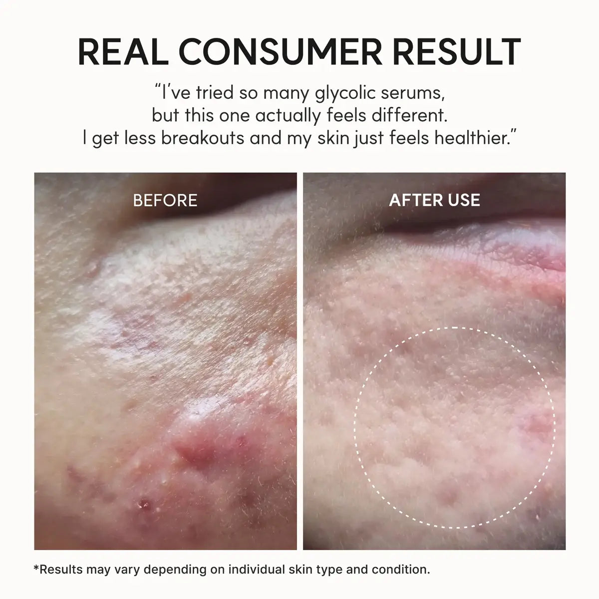 Before and after skin comparison with text indicating a consumer result of using a glycolic serum.
