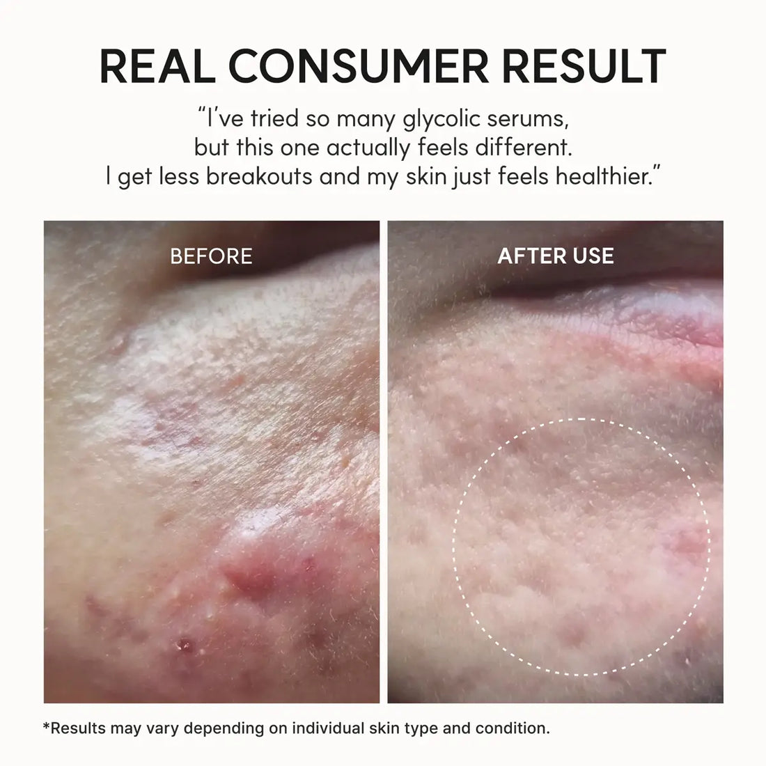 Before and after skin comparison with text indicating a consumer result of using a glycolic serum.