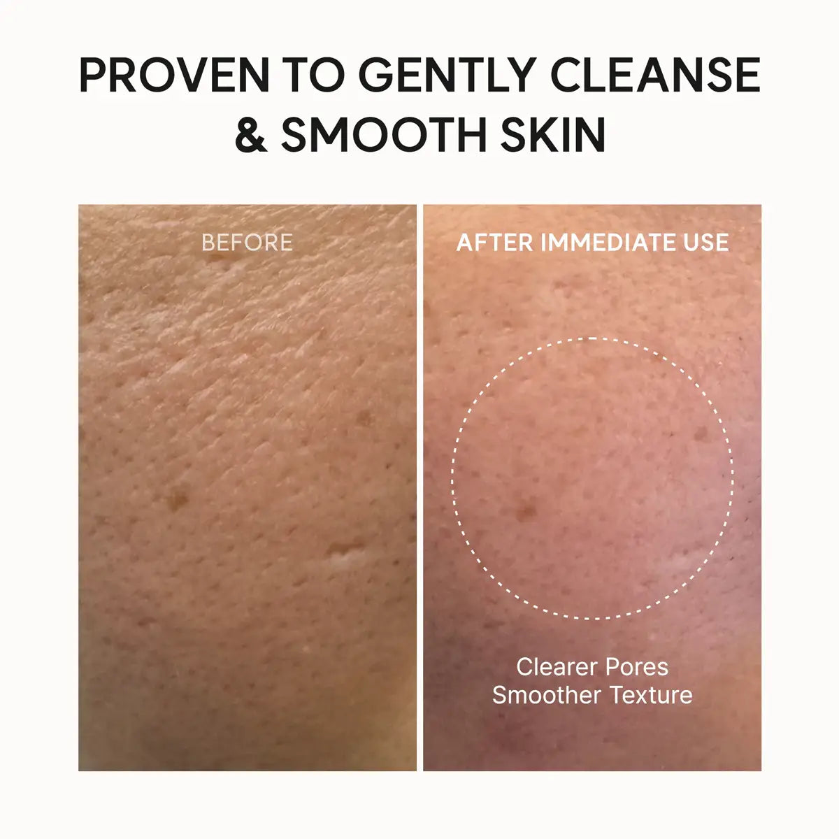 Before and after skin treatment showing clearer pores and smoother texture.