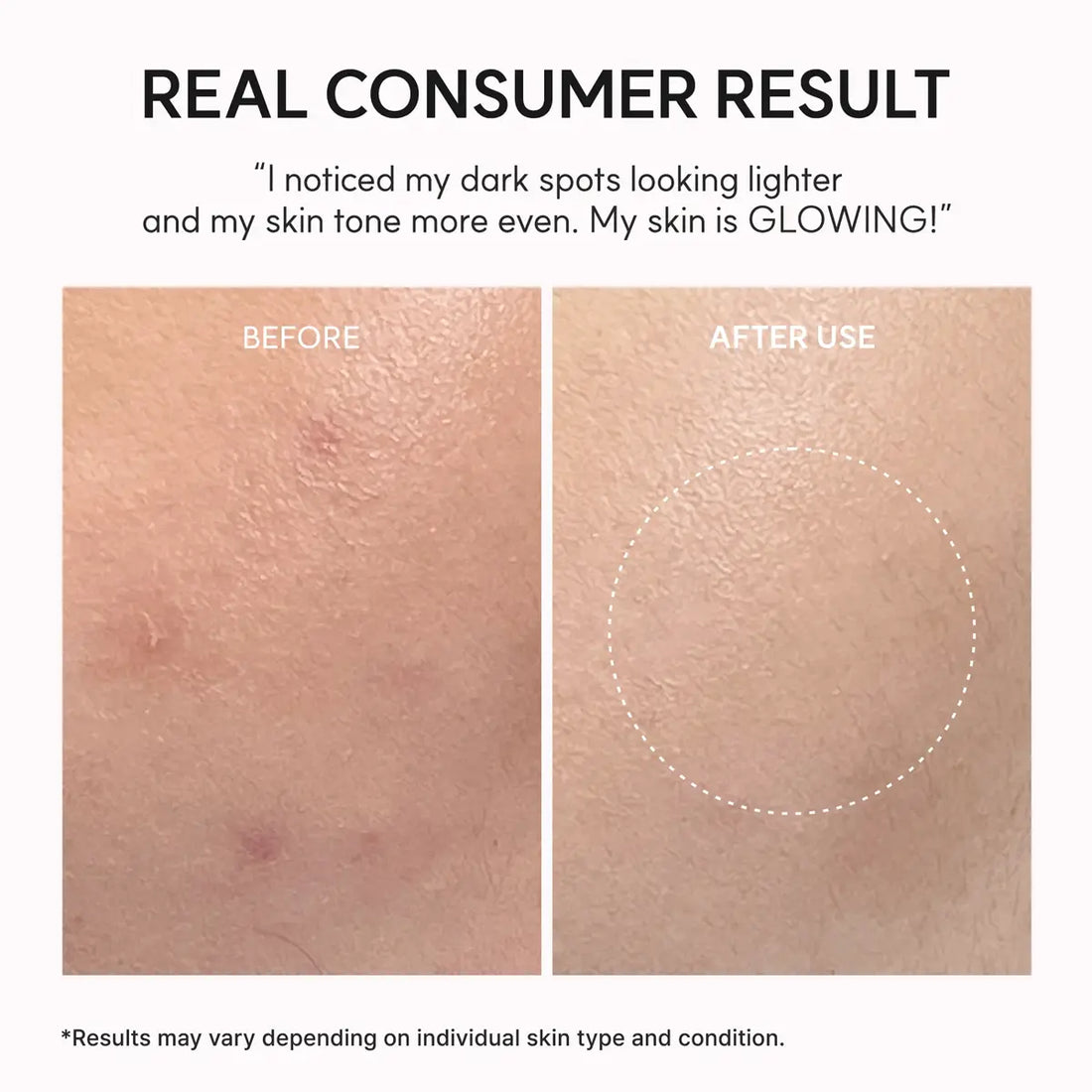 Before & after use of Arencia TXA Booster Shot Serum 30ml