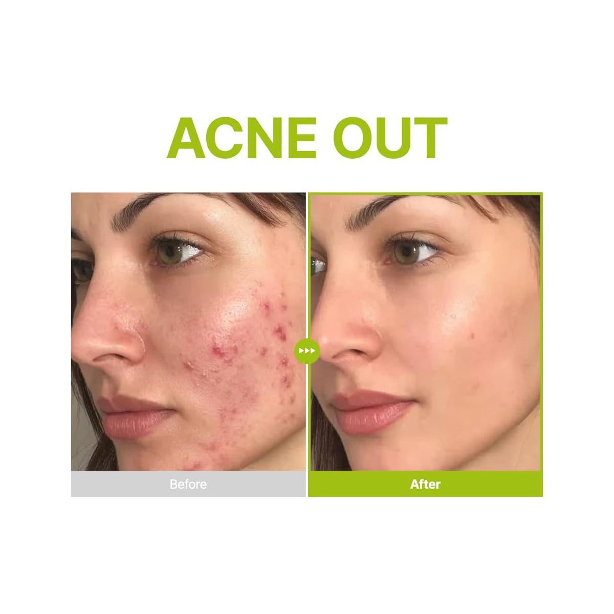 Before and after comparison of acne treatment with 'ACNE OUT' text.