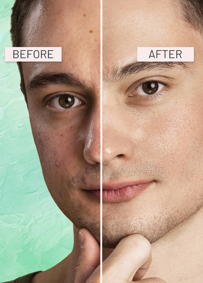 Before and after comparison of a man's face with visible skin improvement.