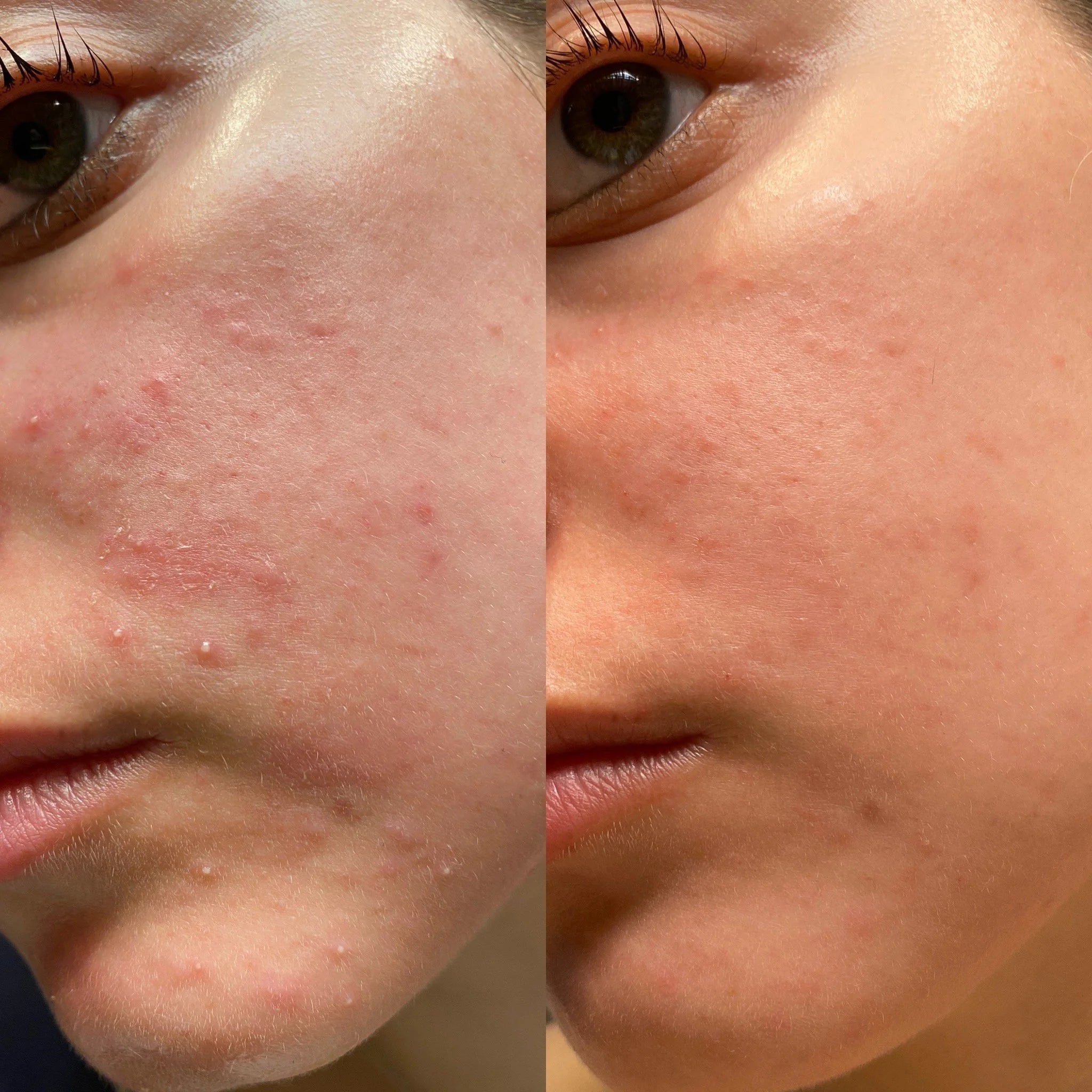 COSRX Centella Blemish Cream 30g