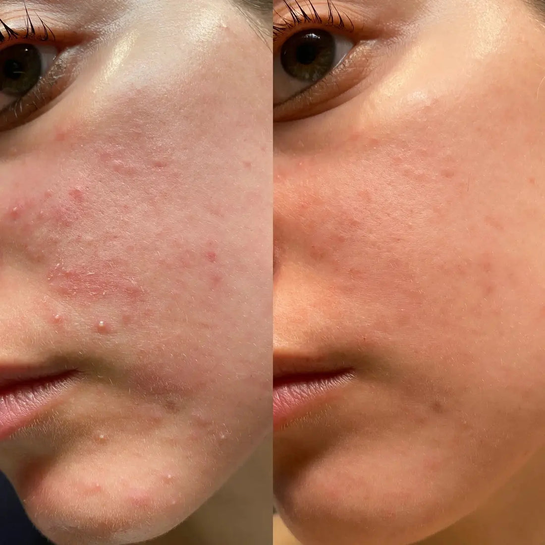 Before and after comparison of a person's face with acne on the left and clear skin on the right.