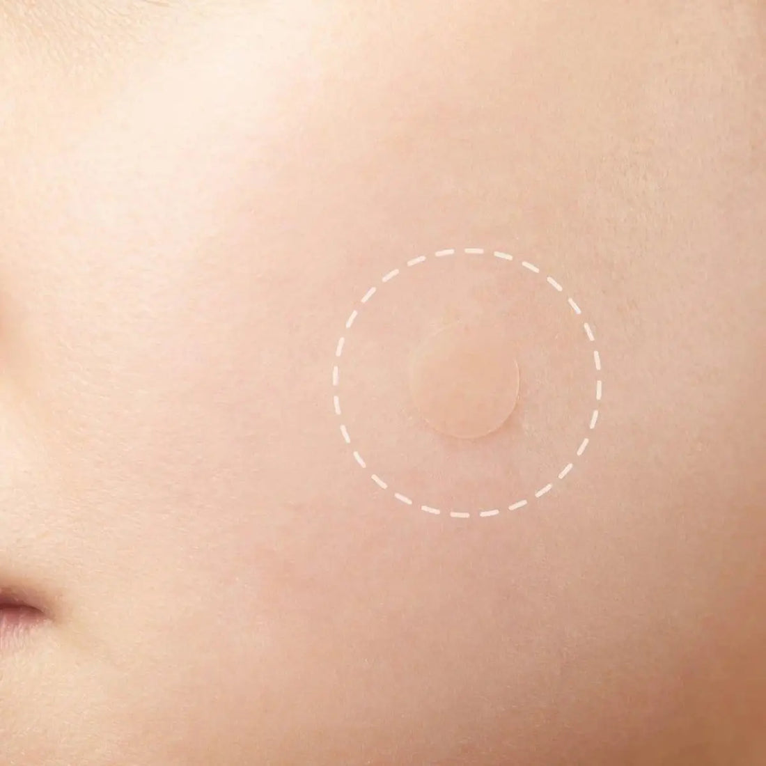 Close-up of a person's skin with a small mole highlighted by a white circle.