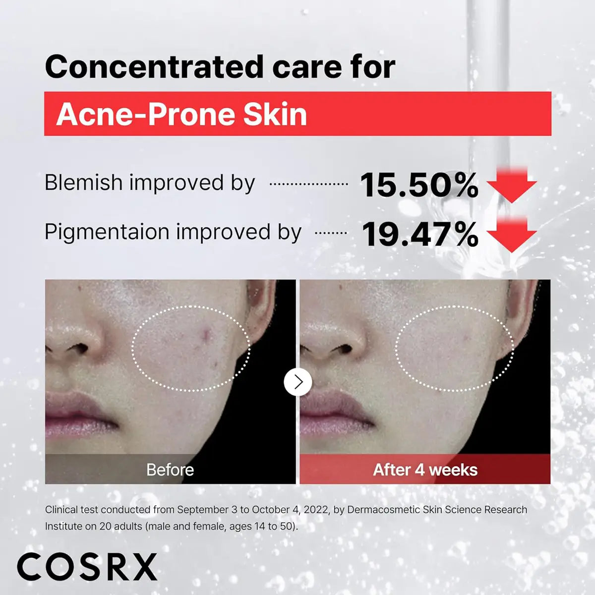 Cosrx skincare product advertisement showing before and after effects on acne-prone skin.