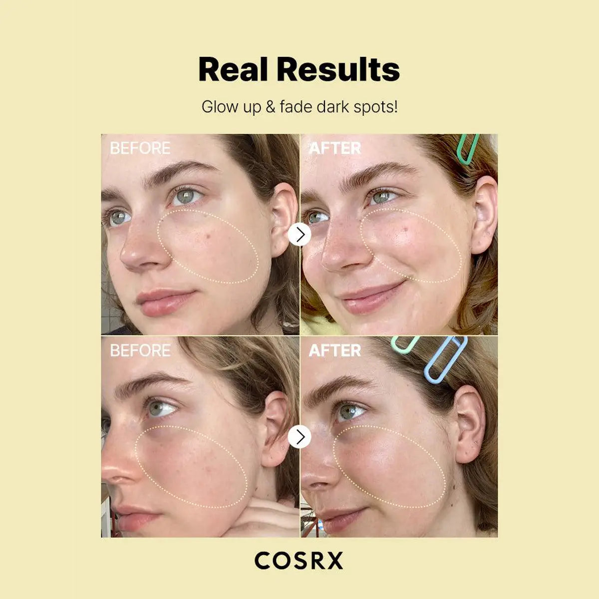 Before and after comparison of skin treatment with COSRX logo on a beige background