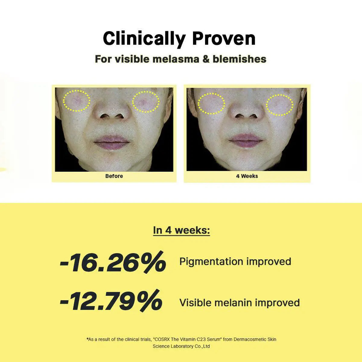 Before and after comparison of skin with melasma and blemishes, showing clinical improvement in 4 weeks.