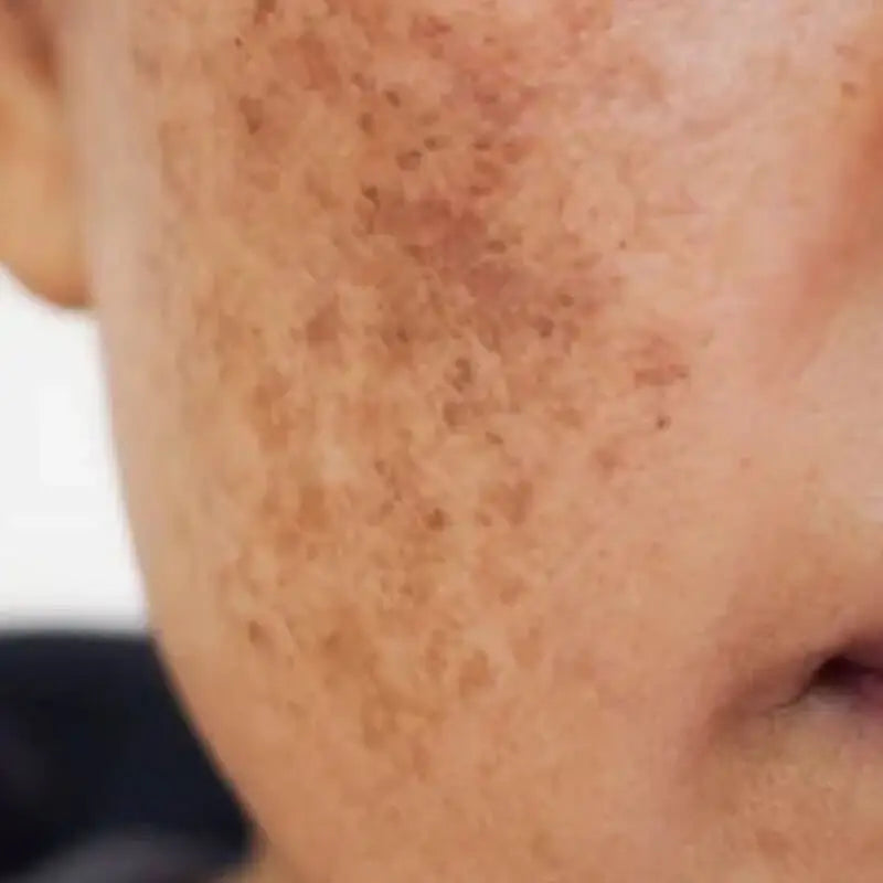 Close-up of a person's face with visible dark spots.