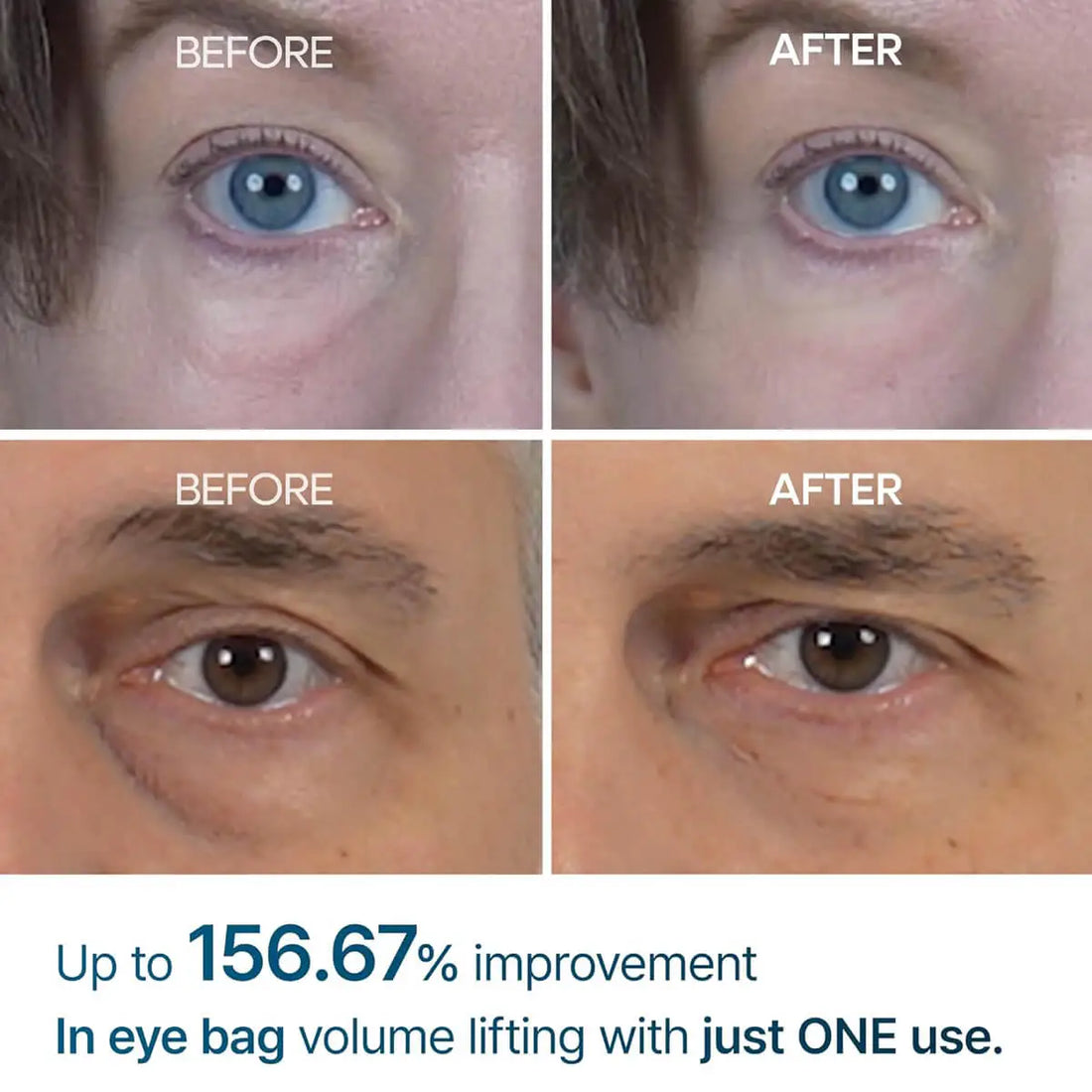 Before and after comparison of eye bags with text indicating improvement.