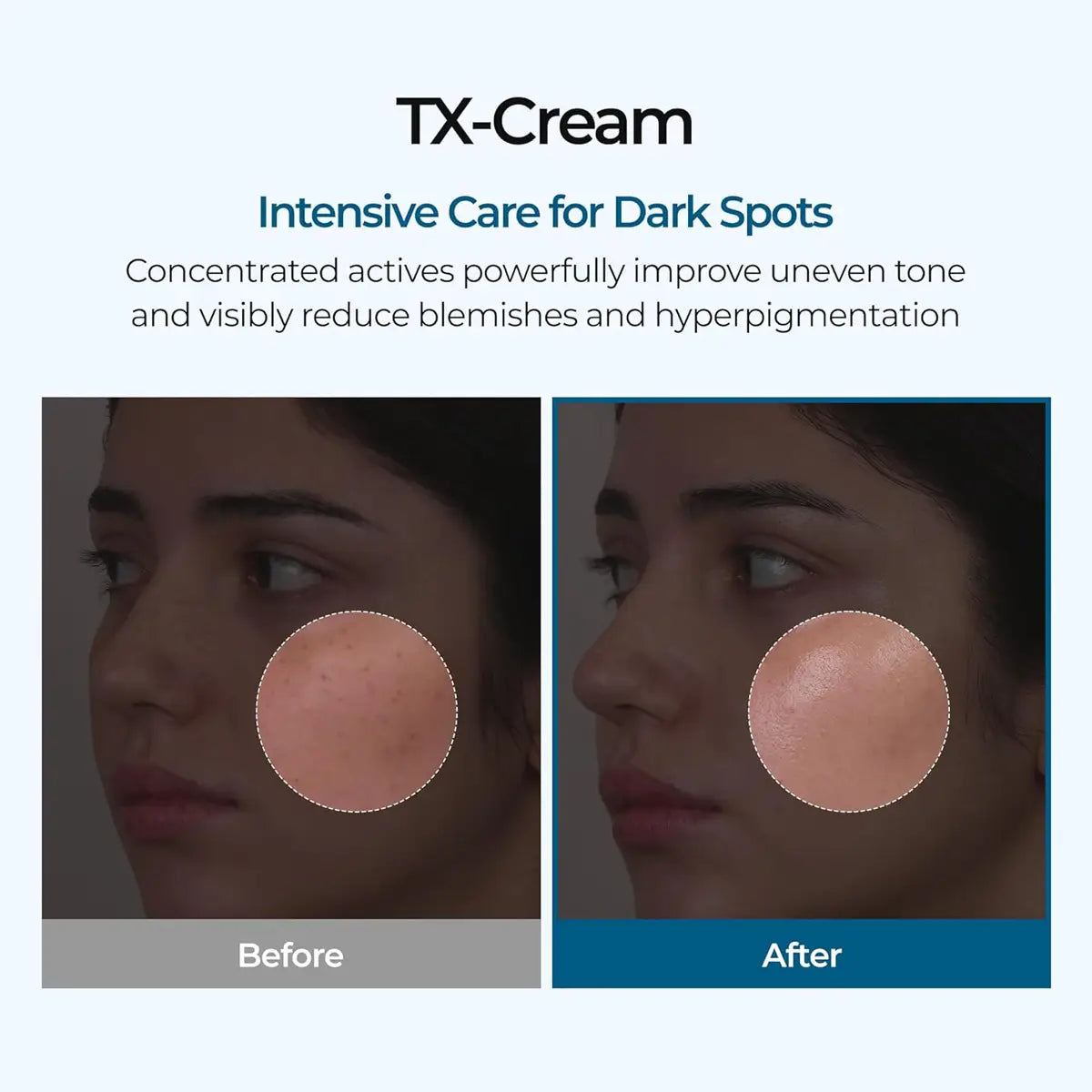 TX-Cream advertisement showing before and after effects on skin with dark spots.
