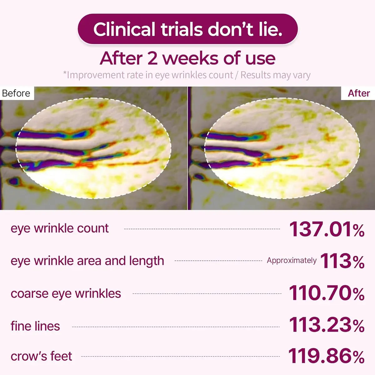 Before and after comparison of eye wrinkles with clinical trial statistics on a purple background.