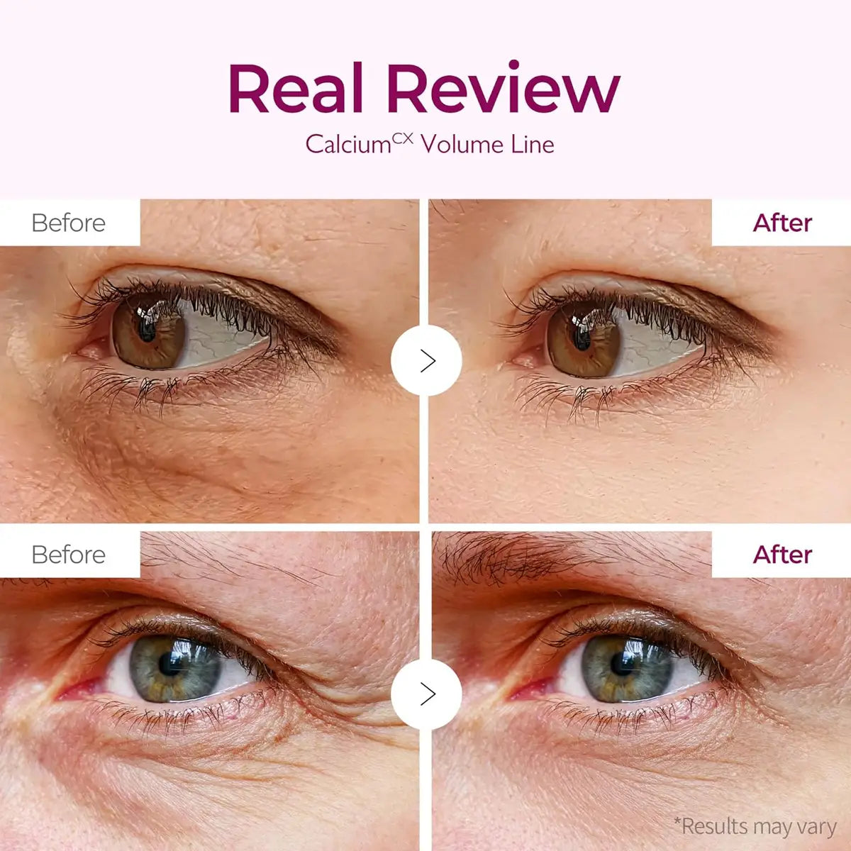 Before and after comparison of eye area treatment with 'Real Review' text.