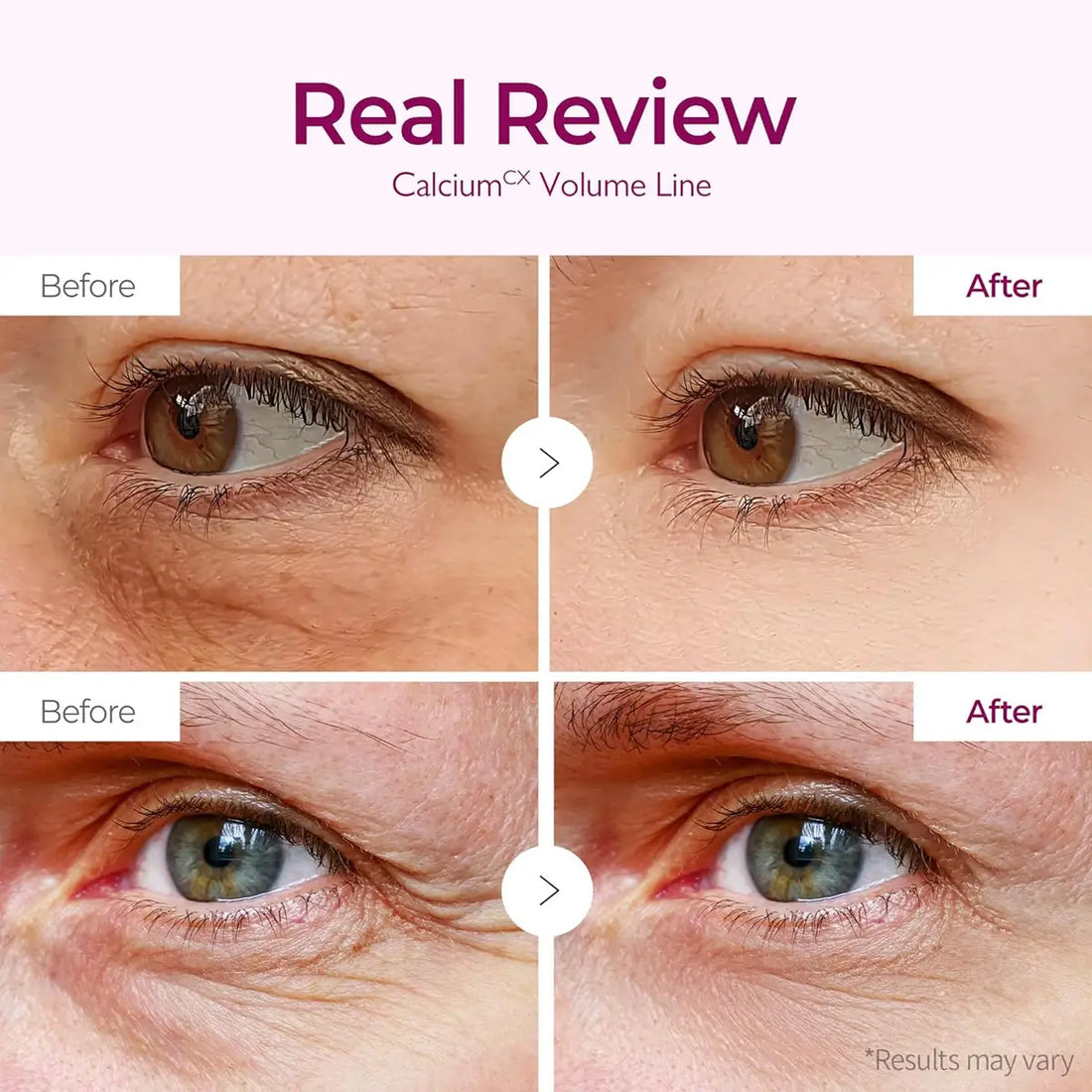 Before and after comparison of eye area treatment with 'Real Review' text.