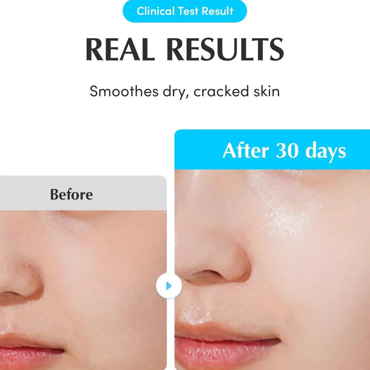 Before and after comparison of dry, cracked skin smoothed by a product after 30 days.