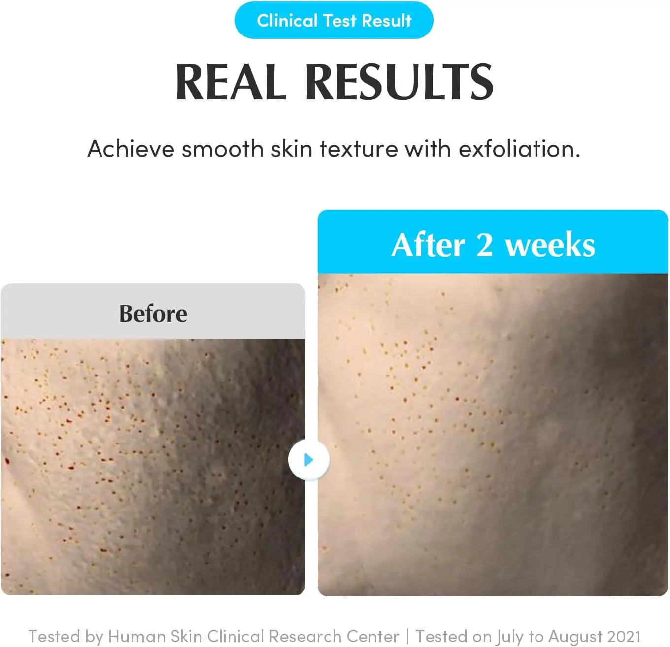 Before and after comparison of skin texture with exfoliation, showing smooth skin after 2 weeks.