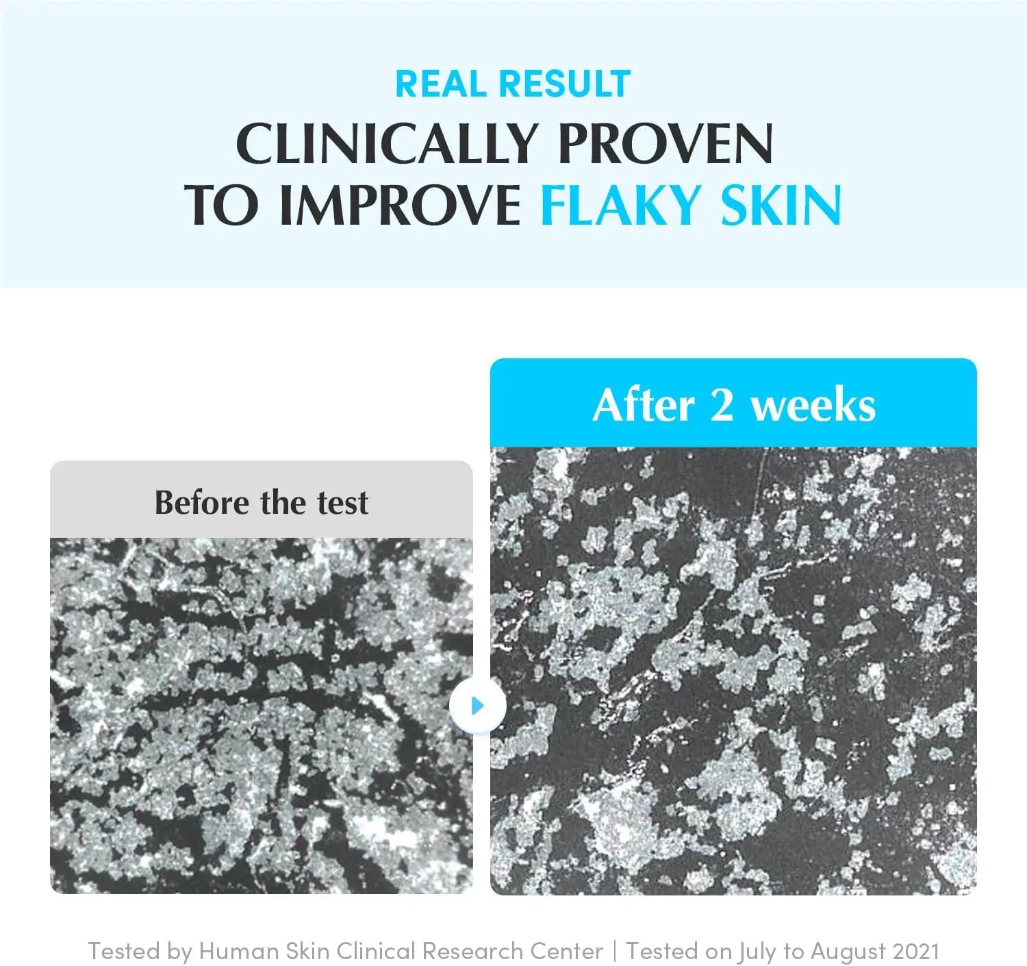 Before and after comparison of flaky skin with text indicating clinical improvement.
