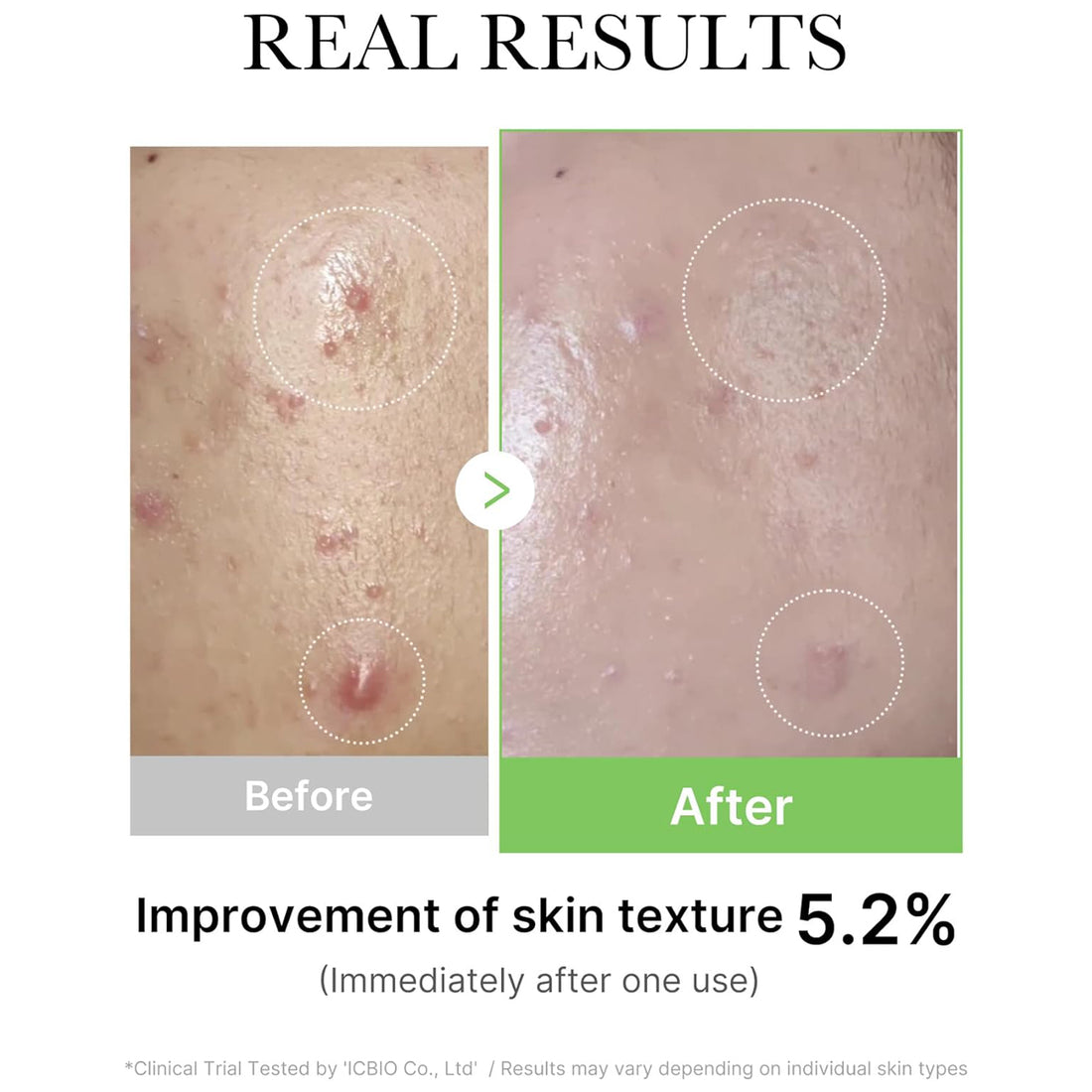 Before and after comparison of skin texture improvement with text 'Real Results' and 'Improvement of skin texture 5.2%'.