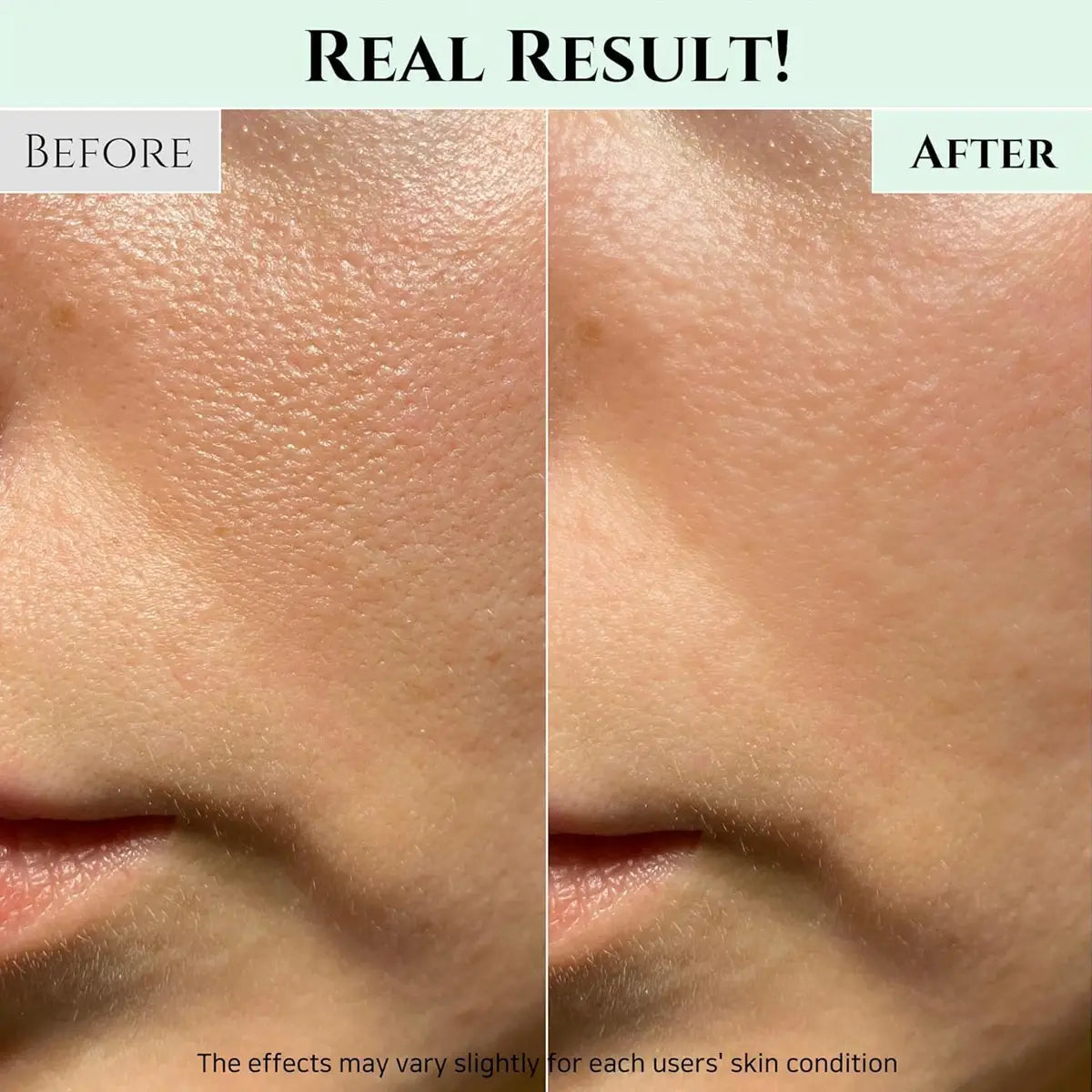 Before and after comparison of skin texture on a person's face with text 'Real Result!' at the top.
