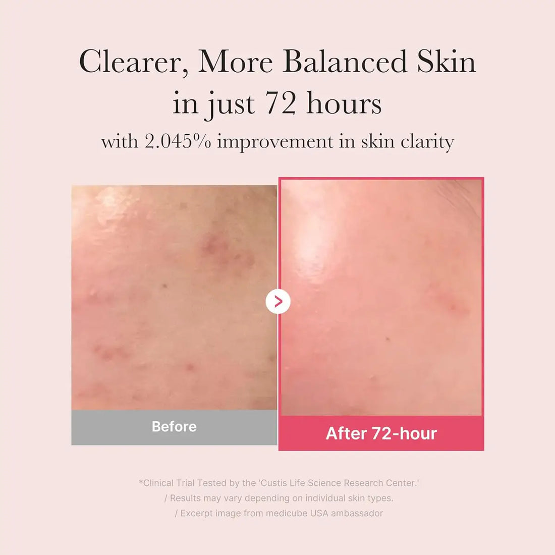 Before and after comparison of skin clarity improvement in 72 hours with Medicube TXA+Niacinamide 15 Glow Facial Serum.