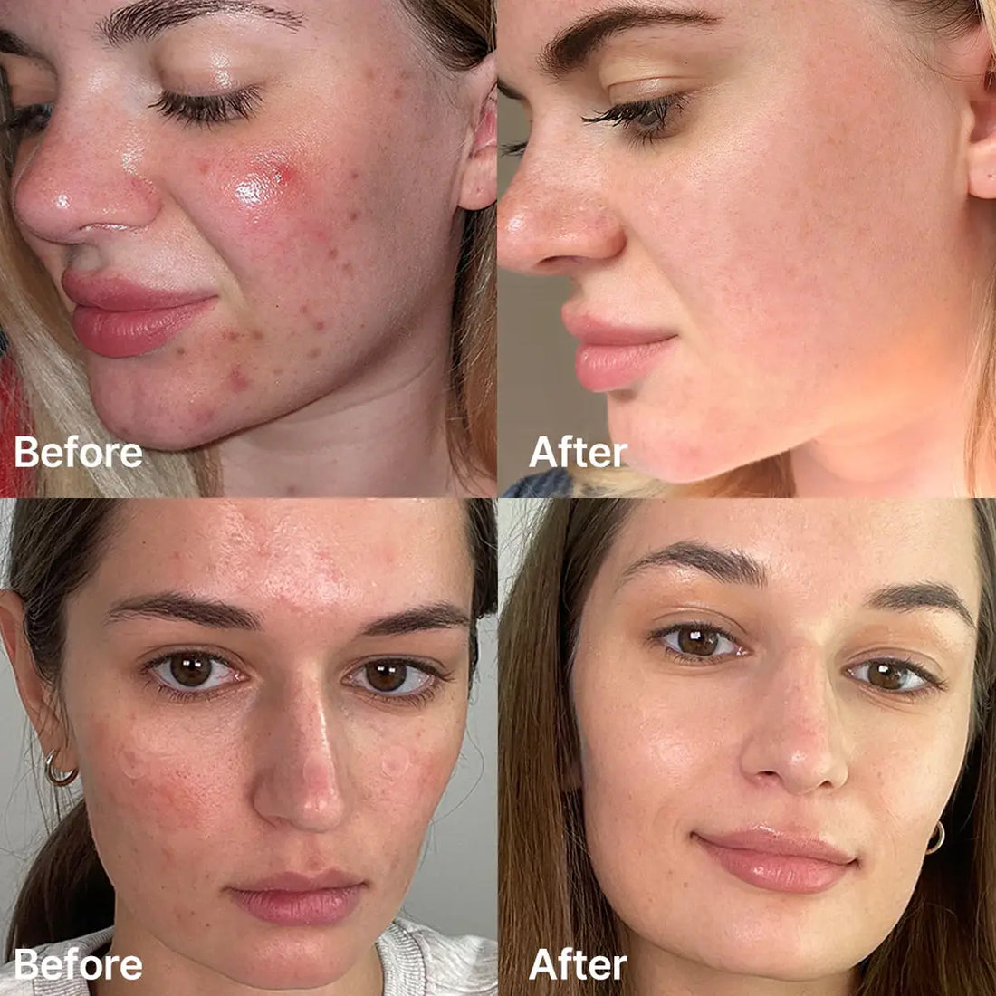 Before and after comparison of a woman's face with acne treatment.