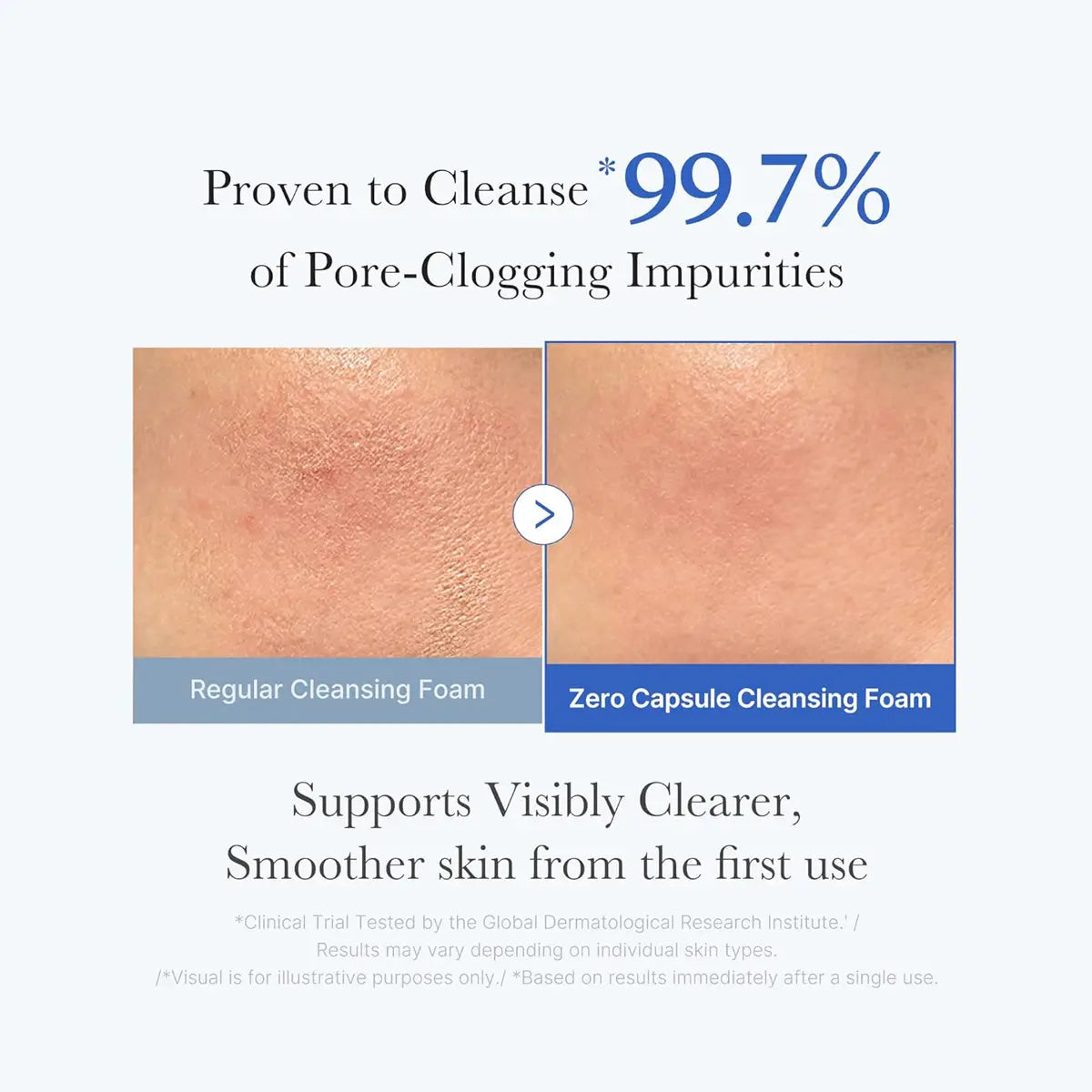 Comparison of skin with regular cleansing foam and Zero Capsule Cleansing Foam, highlighting effectiveness in cleansing pores.