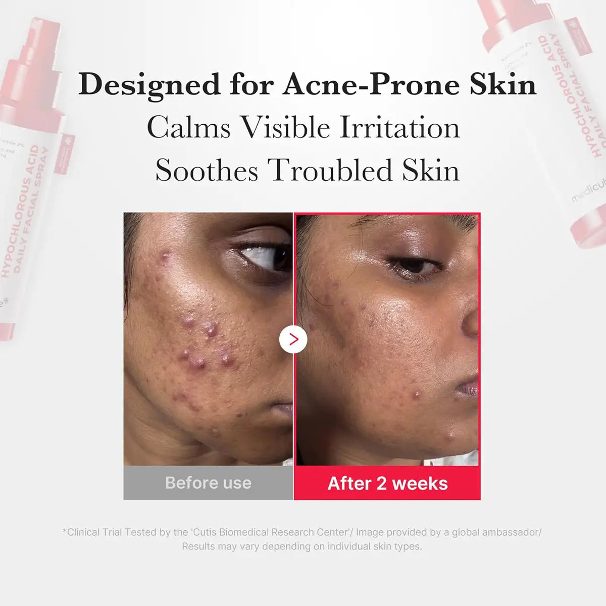 Before and after comparison of acne-prone skin with product packaging on a white background.