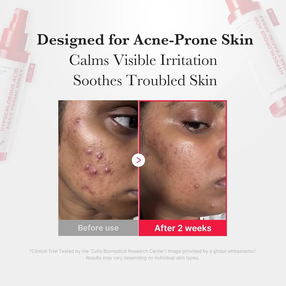 Before and after comparison of acne-prone skin with product packaging on a white background.