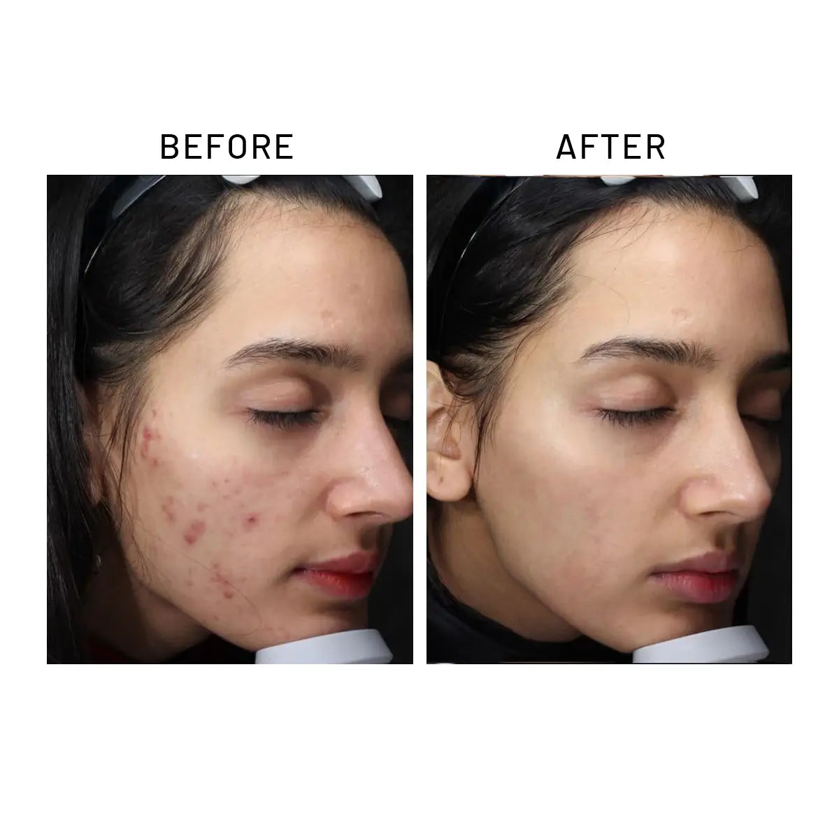 Before and after results showcasing acne improvement using Medicube Red Line Full Set with Red Solution Kit Bundle.