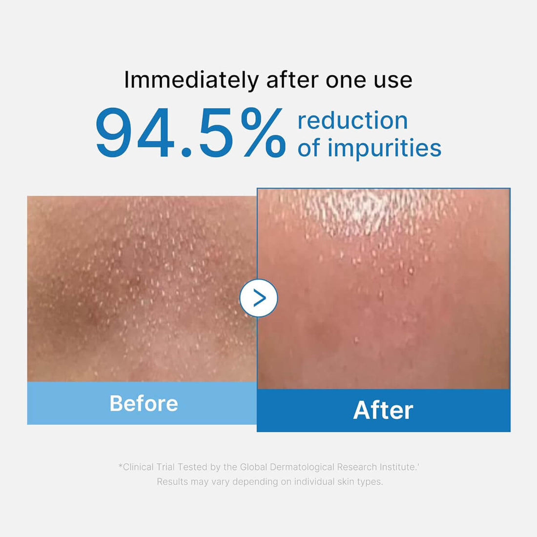 Before and after image showing 94.5% reduction of impurities from using Medicube Cleansing Oil.