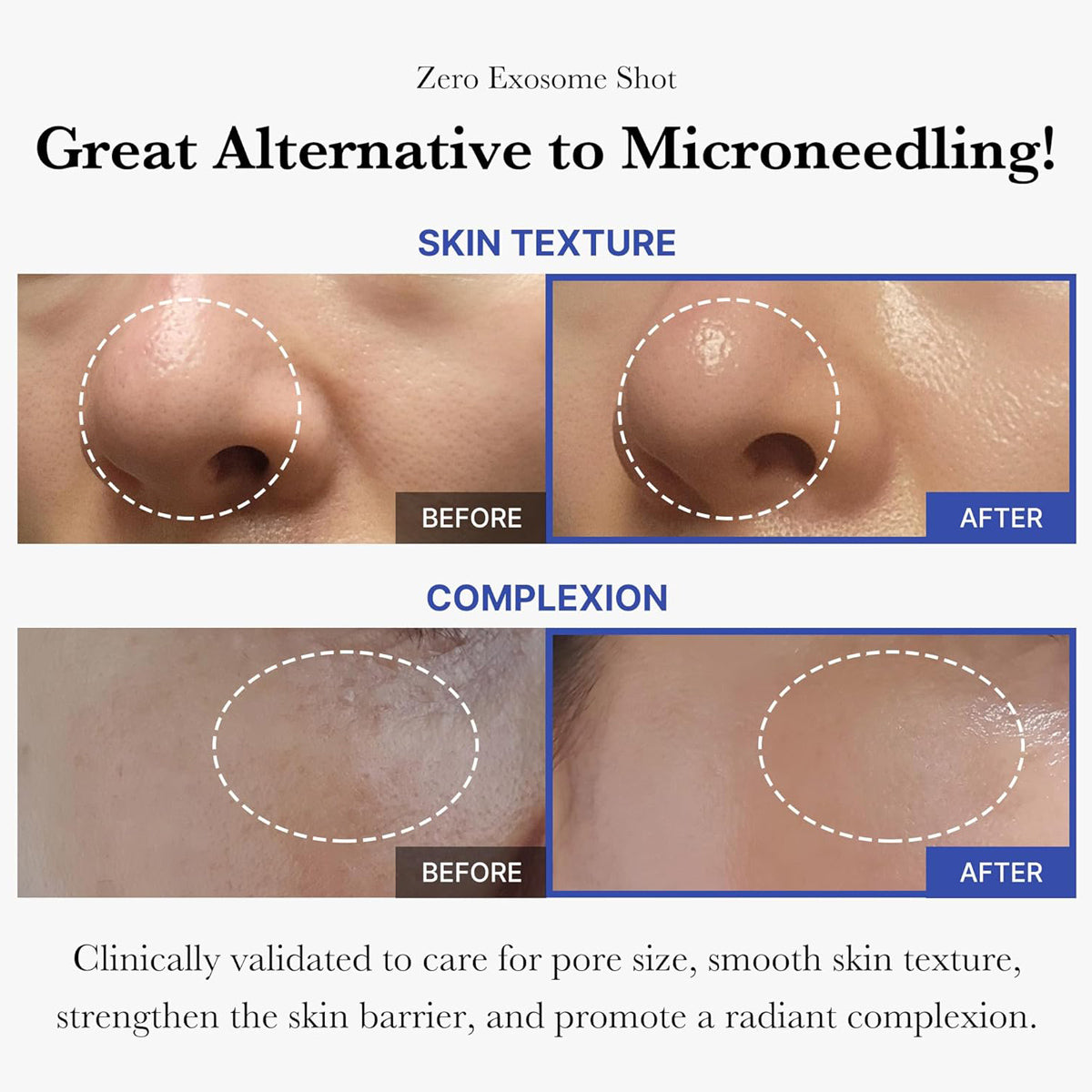 Before and after comparison of skin texture and complexion with text about a 'Zero Exosome Shot' treatment.
