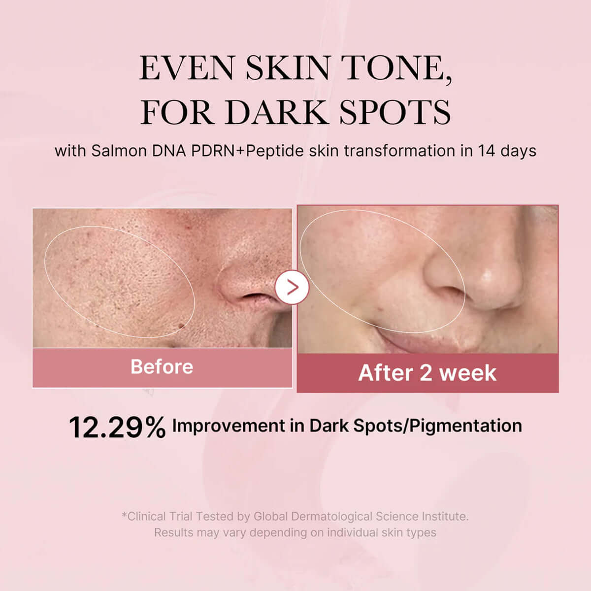 Before and after skin transformation showing improvement in dark spots and pigmentation with Salmon DNA PDRN+Peptide treatment.