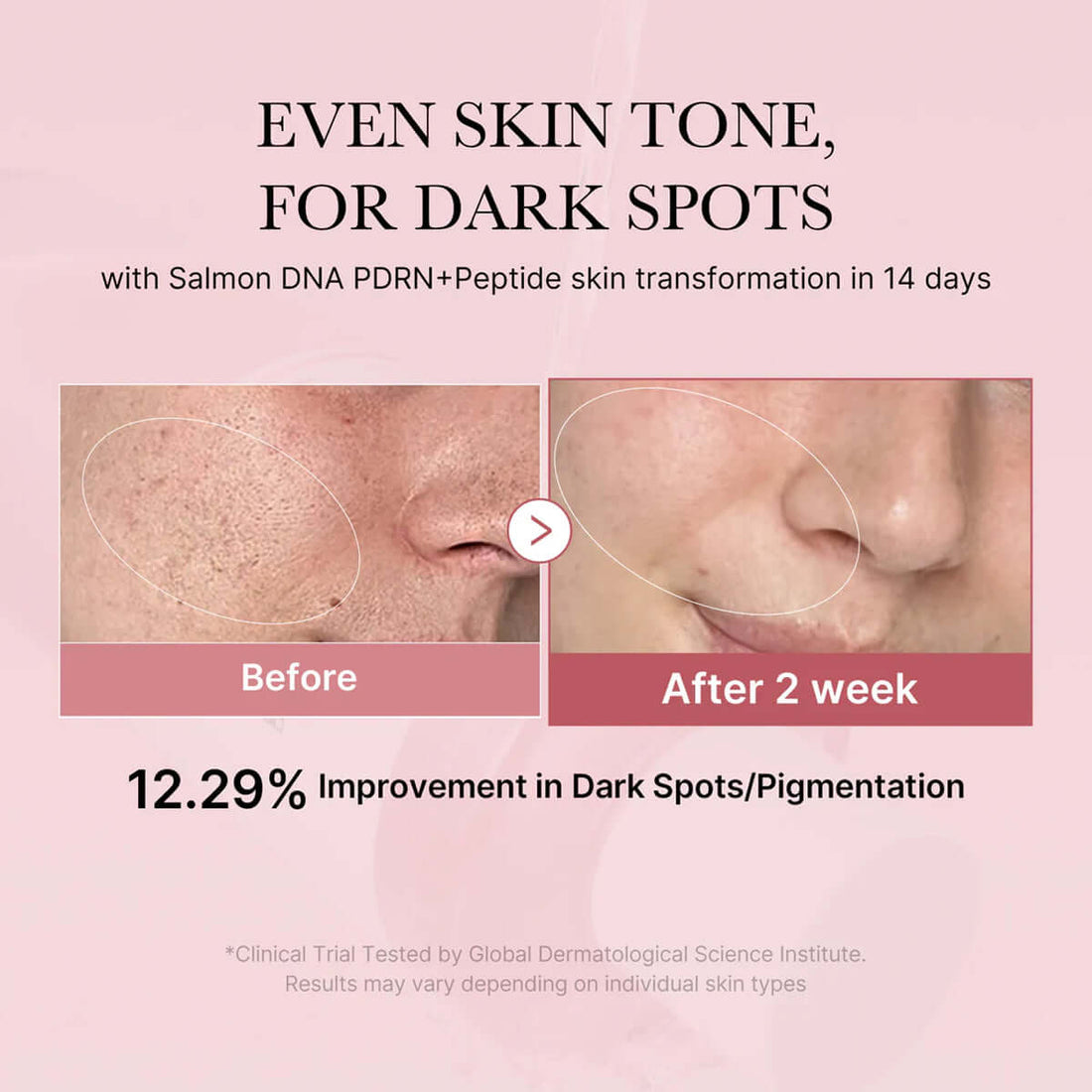 Before and after skin transformation showing improvement in dark spots and pigmentation with Salmon DNA PDRN+Peptide treatment.