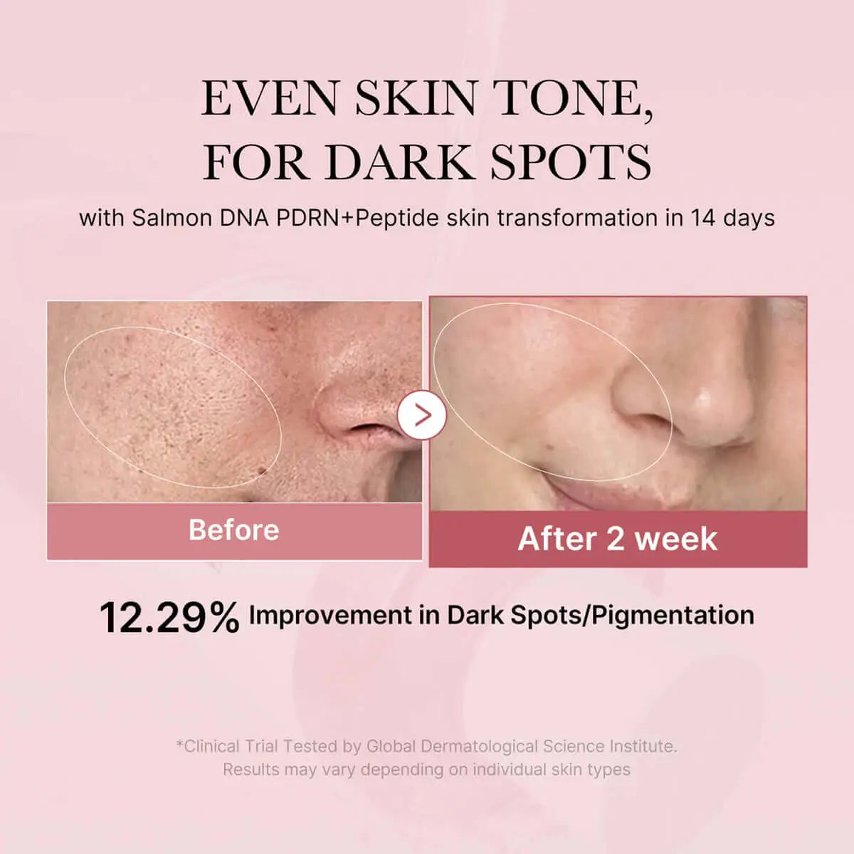 Before and after skin transformation showing improvement in dark spots with Rose PDRN+Peptide treatment.