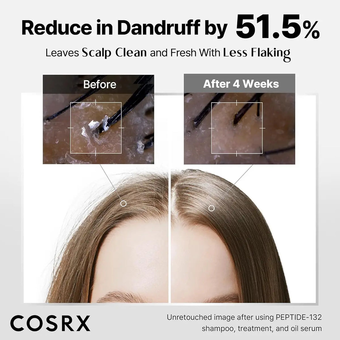 Cosrx shampoo treatment before and after dandruff reduction on scalp and hair.