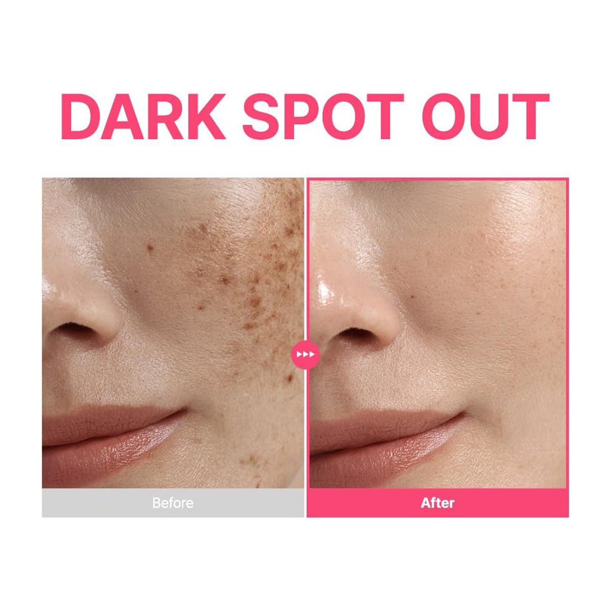 Before and after comparison of dark spots on skin with 'Dark Spot Out' text.