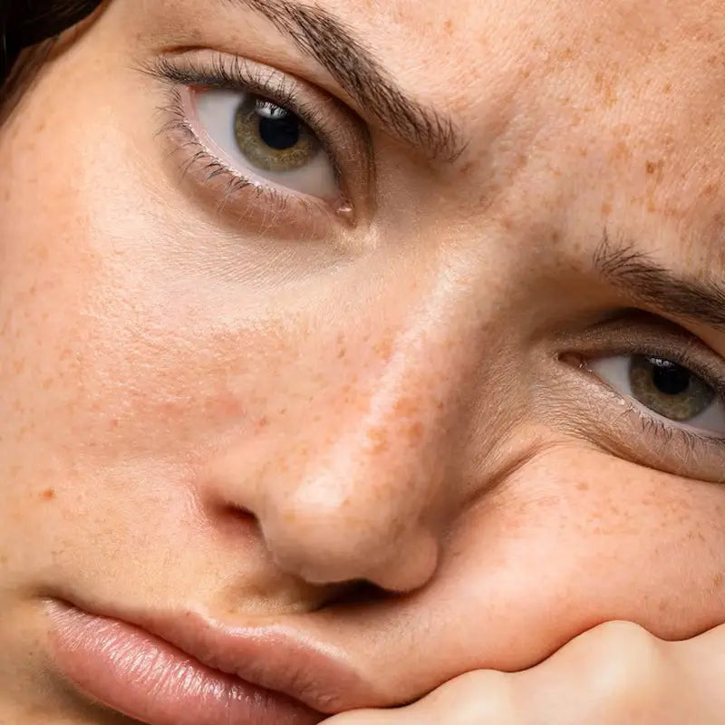 Close-up of a person's face with skin pigmentation.