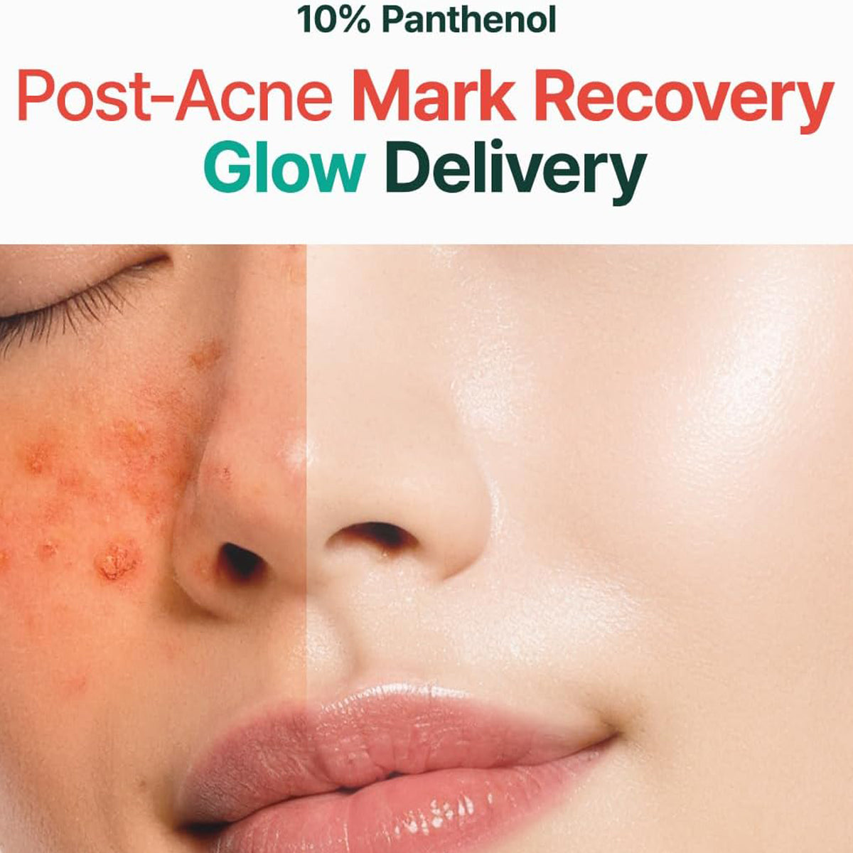 Before and after comparison of a face with acne marks and smooth skin, labeled '10% Panthenol Post-Acne Mark Recovery Glow Delivery'.