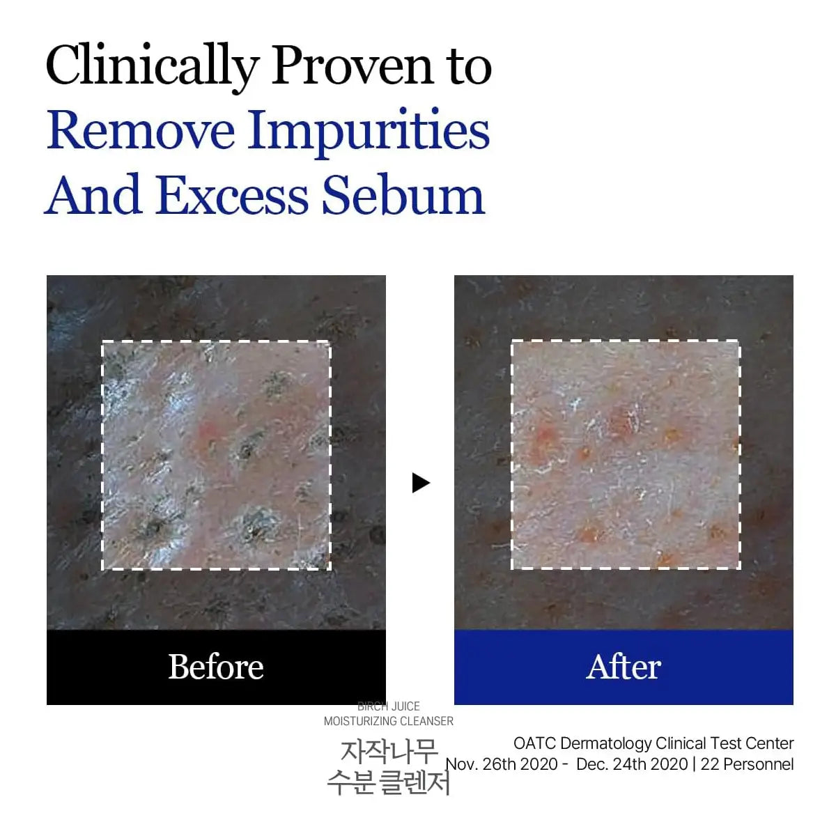 Before and after comparison of skin with impurities and excess sebum, clinically proven to remove them.