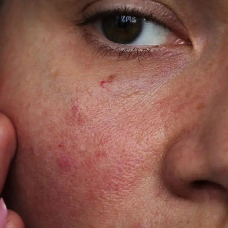 Close-up of a person's face with visible redness on skin.