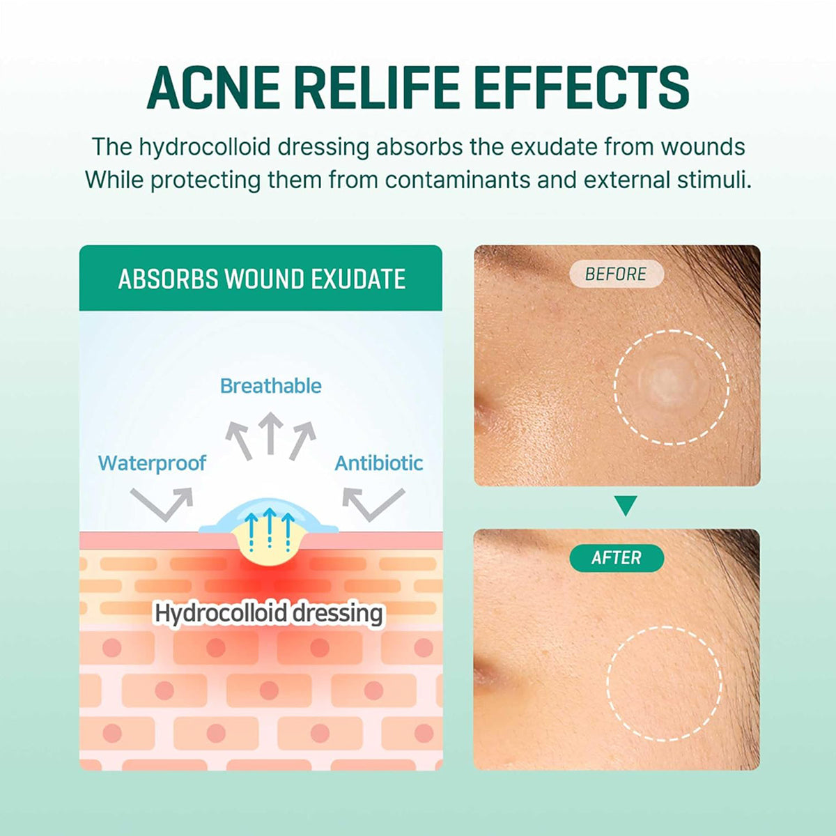 SOME BY MI 30 Days Miracle Clear Spot Patch – Korean acne pimple patches for fast healing and discreet wear. Effects