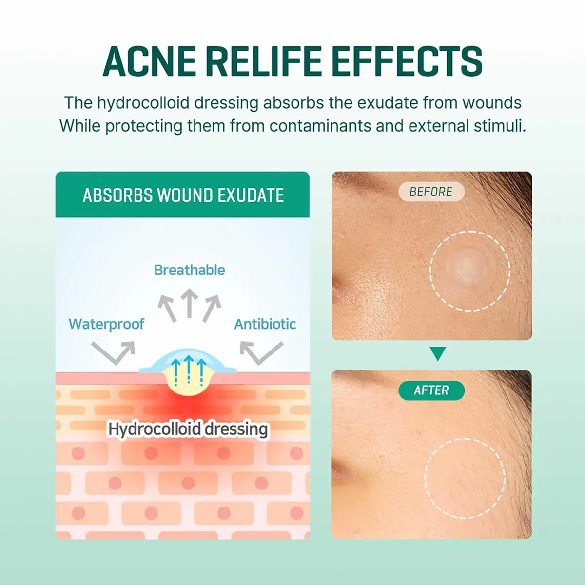 SOME BY MI 30 Days Miracle Clear Spot Patch infographic showing acne relief effects and hydrocolloid dressing benefits.
