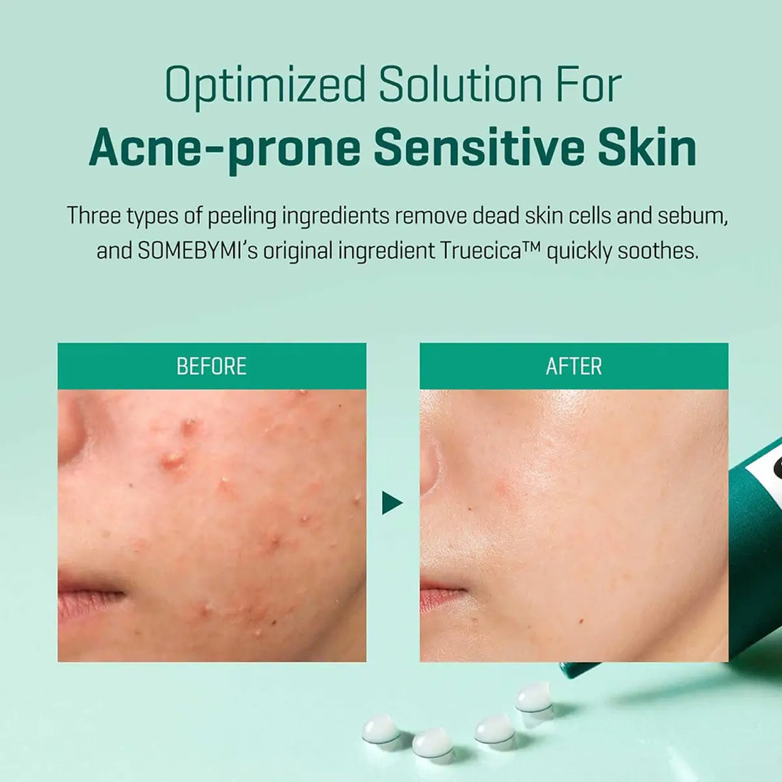 Image showing before and after results of SOME BY MI AHA BHA PHA 14 Days Super Miracle Spot All Kill Cream 30mL on acne-prone skin.