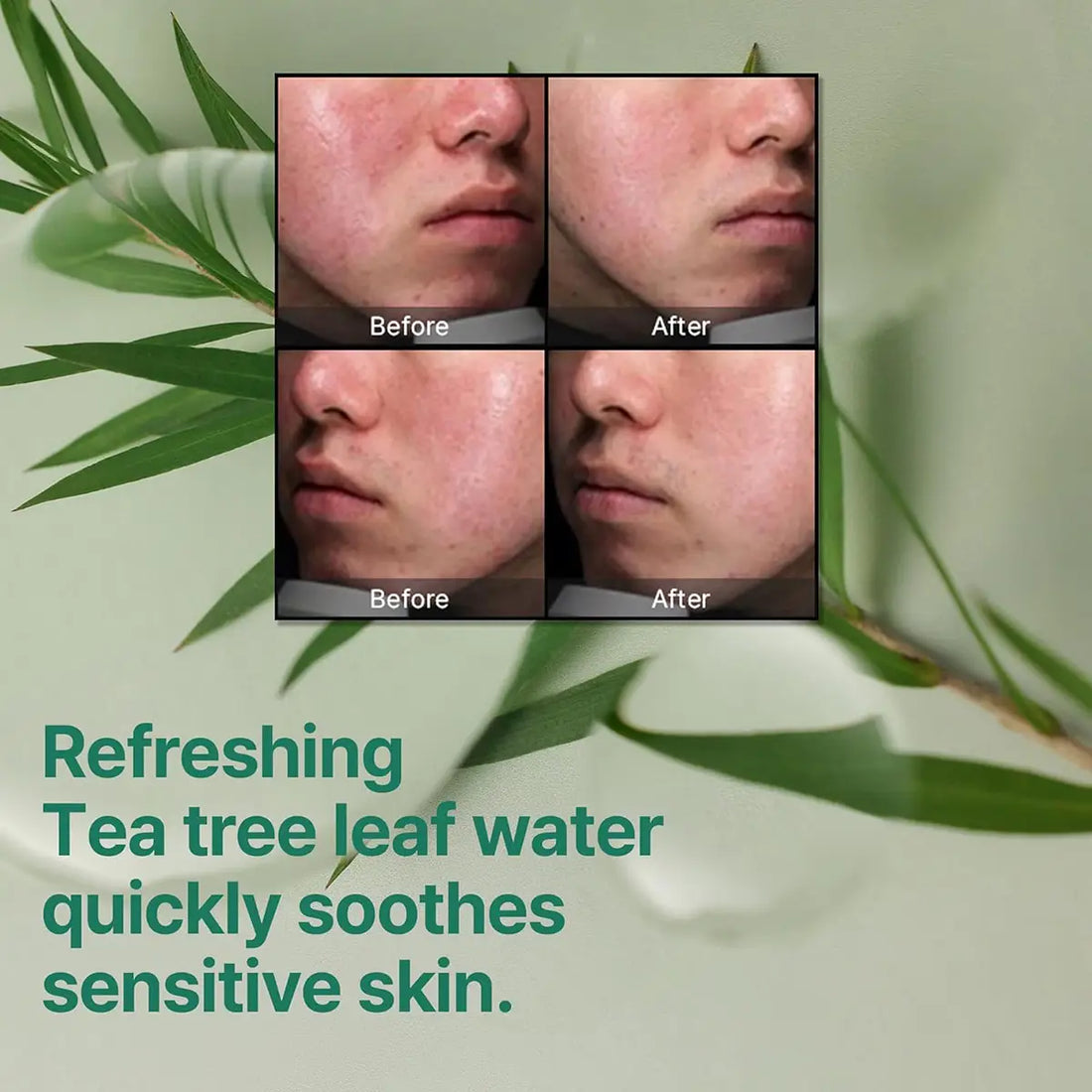 Before and after comparison of skin using SOME BY MI AHA BHA PHA Miracle Cream 60g for clearer, calmer skin.